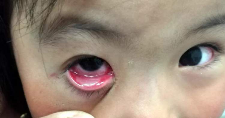 孩子眼红眼痒眼屎多,有眨眼…都是"结膜炎"?