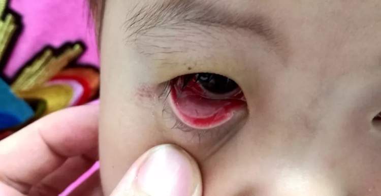 孩子眼红眼痒眼屎多,有眨眼…都是"结膜炎"?