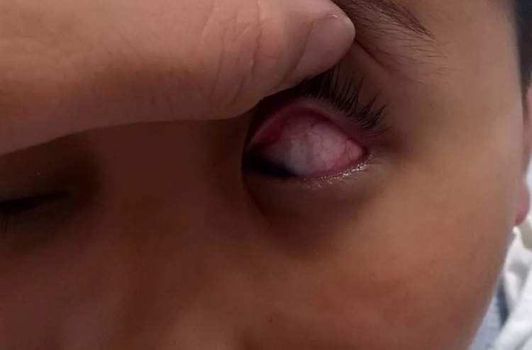 如果不看裂隙灯,这个虹膜炎很容易被忽视,误诊为红眼病.