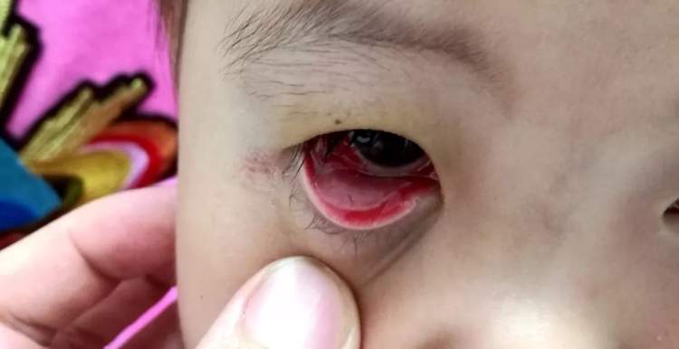 孩子眼红眼痒眼屎多有眨眼都是结膜炎眼科门诊最常见的眼病也有大学问