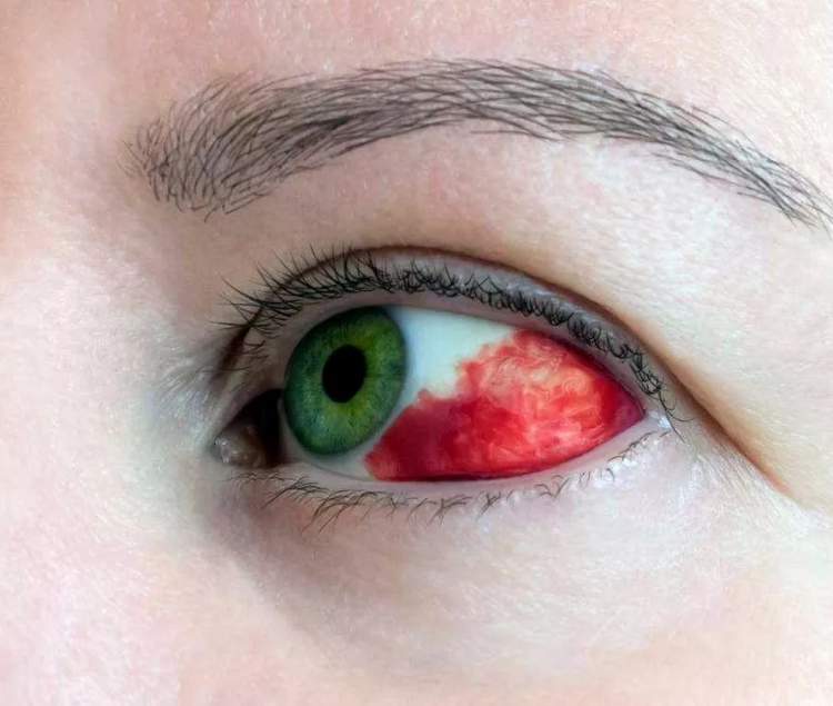 孩子眼红眼痒眼屎多有眨眼都是结膜炎眼科门诊最常见的眼病也有大学问