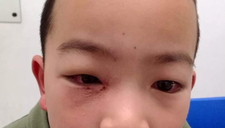 孩子眼红眼痒眼屎多有眨眼都是结膜炎眼科门诊最常见的眼病也有大学问