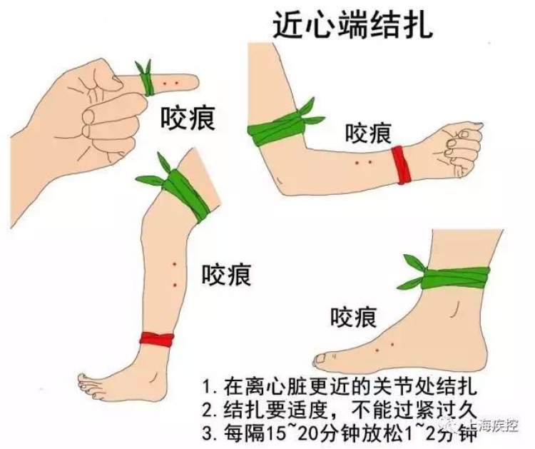 一绑扎被毒蛇咬伤后,应立即在咬伤部位近心端5～10cm处进行绑扎,就地