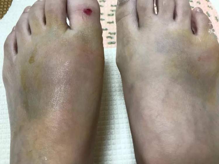 成年女子在亲子餐厅玩滑梯致脚受伤谁该担责