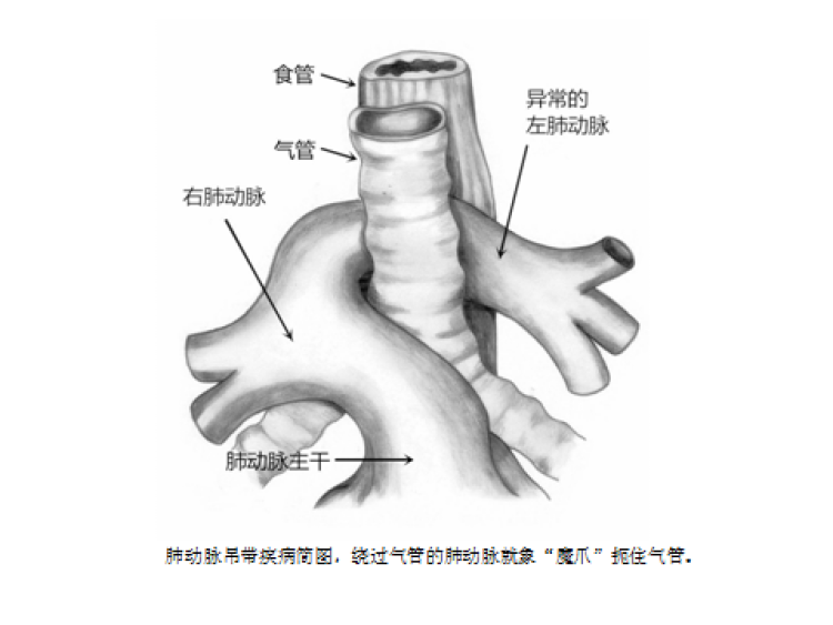 周到上海 健康 医药 正文肺动脉吊带是一种非常罕见的先天性心血管
