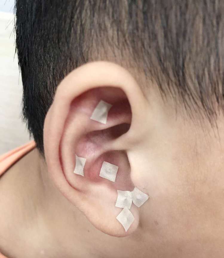 近视中医干预门诊以中医外治法为主,包括中药超声雾化熏眼,耳穴贴压及