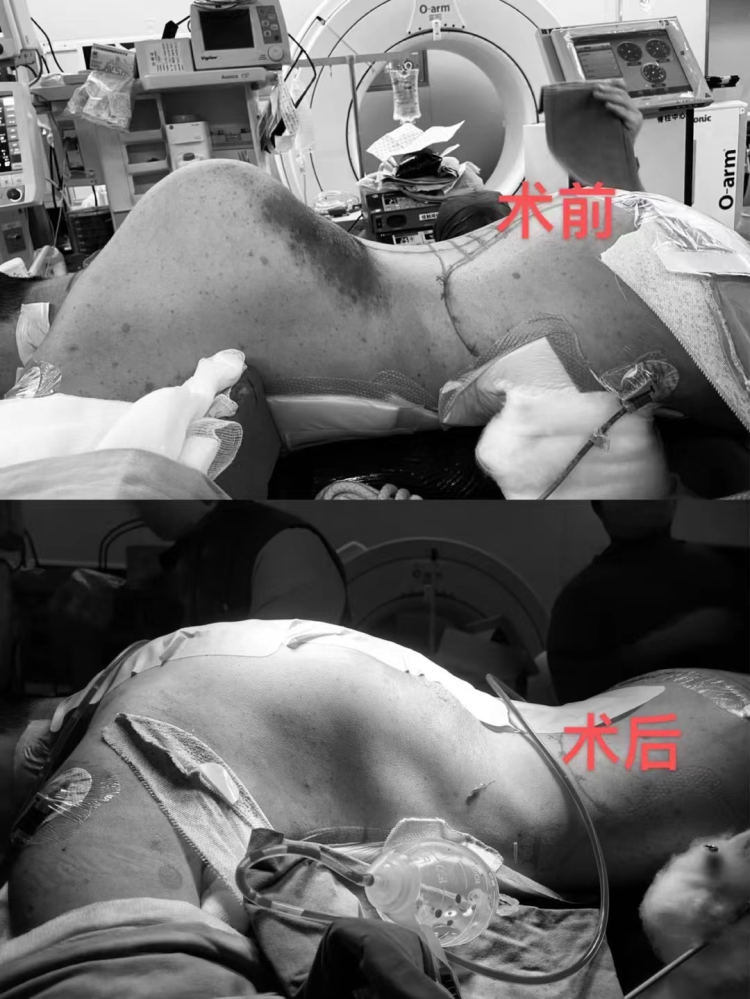 20岁女大学生脊柱侧弯近180奇迹高难度矫治术后她长高12厘米