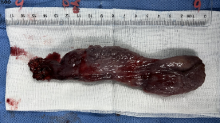 男子咽喉不适,声音嘶哑,以为是咽炎,谁知竟是16cm肿物"封喉"!