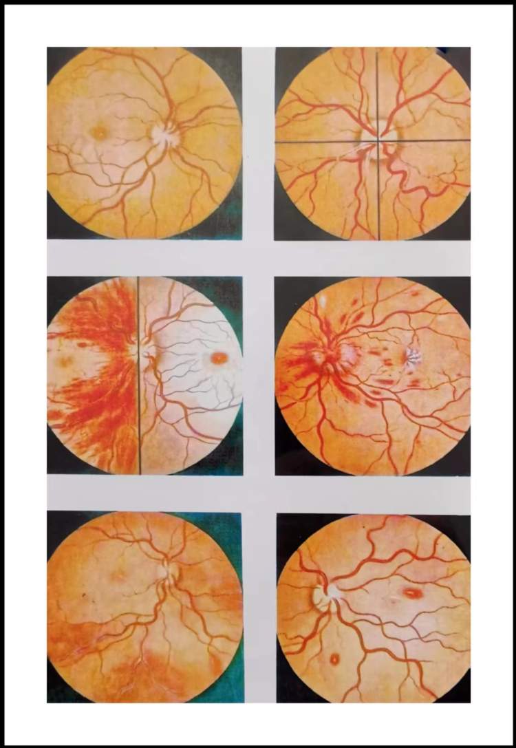 他画的眼底图被收入《医学百科全书》