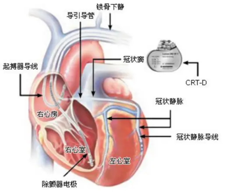 起搏器位置图片图片